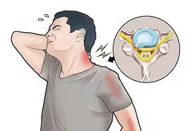 انزلاق الغضروف العنقي