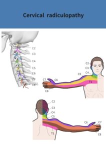 انزلاق غضروف الرقبة