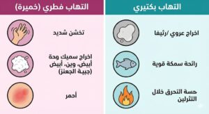 أعراض وعلاج التهاب المهبل الفطري