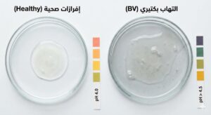 الالتهاب البكتيري للمهبل