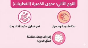 عدوى الخميرة من أنواع التهابات المهبل