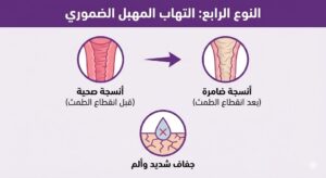 أنواع التهابات المهبل